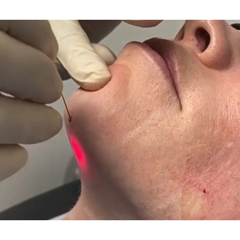 Facial Lifting Dual 1470nm 980nm Lifting Lipo Lipolysis EndoSkin Laser Lifting 1470