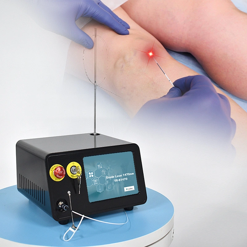2024 Best Price 1470nm  Diode Laserlaser Varicose Leg Veins Removal Machine for Blood Vessel Wall Burning