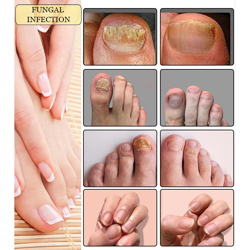 Nail Fungus Treat High Power 30w Podiatry Laser 980nm Diode Laser Machine