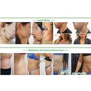 980nm Endolaser Lift  Liposuction Lipolysis Laser 1470nm Vaser Diode Laser Body Contouring