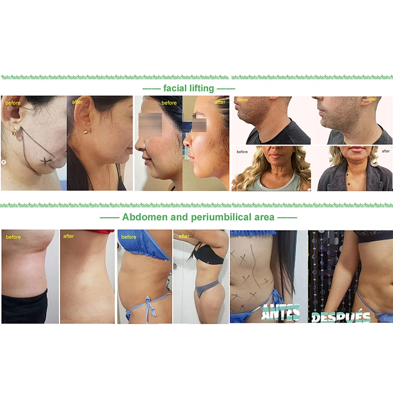 980nm Endolaser Lift  Liposuction Lipolysis Laser 1470nm Vaser Diode Laser Body Contouring