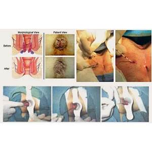 980nm 1470nm Diode Laser for Hemorrhoids Removal Surgery Proctology Haemorrhoids Cutting