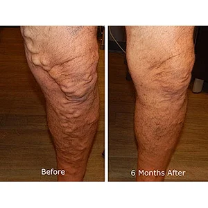 Diode Laser Ablation EVLT1470nm Endovenous Laser Varicose Vein Treatment Device/Spider Veins Vascular Removal Machine