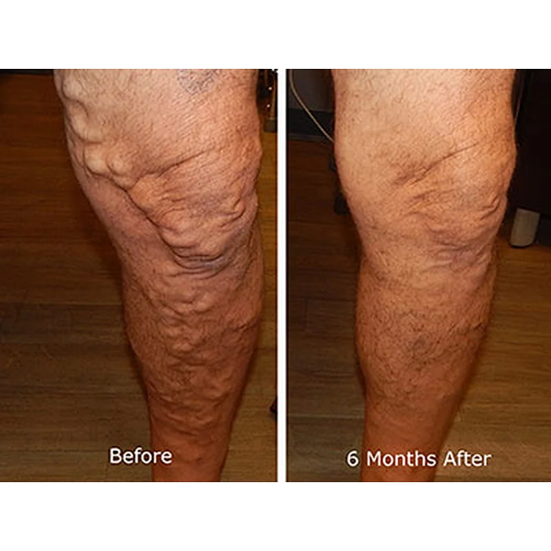Diode Laser Ablation EVLT1470nm Endovenous Laser Varicose Vein Treatment Device/Spider Veins Vascular Removal Machine