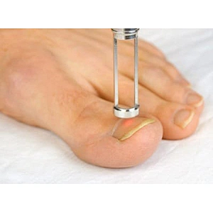 Foot Nail Fungus Laser Treatment Device Toe Nail Laser Fungus Treatment Professional Podiatry Podiatrist Use