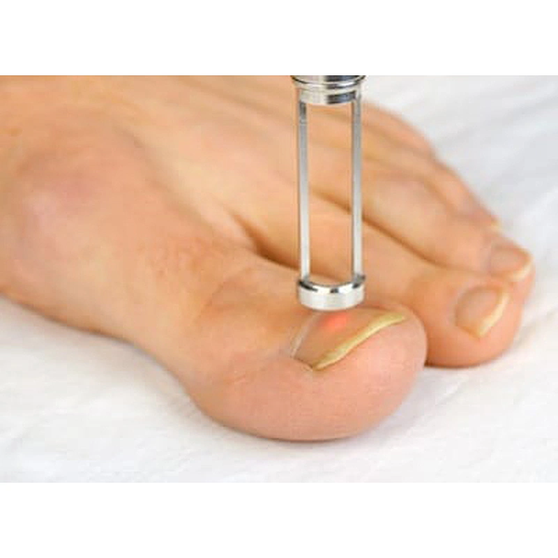 Foot Nail Fungus Laser Treatment Device Toe Nail Laser Fungus Treatment Professional Podiatry Podiatrist Use