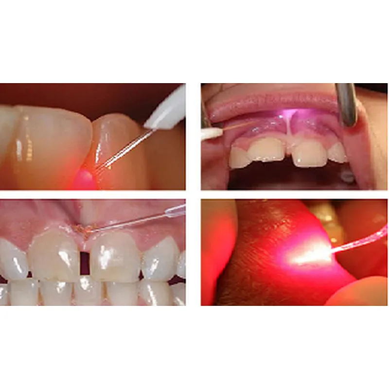 980nm 1470nm 47W Diode Laser Machine Surgery Tooth Whitening Oral Therapy Dental Laser