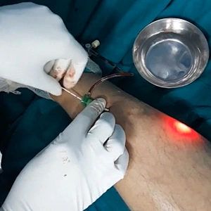 SMA905 International Standard Laser for Varicose Veins Leg Veins Removal Laser Machine