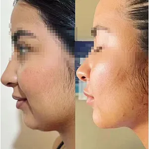 Hot Sale Newest Vaser Liposuction Machine 980nm 1470nm Fiber Diode Laser Endolaser Face Lifting Equipment