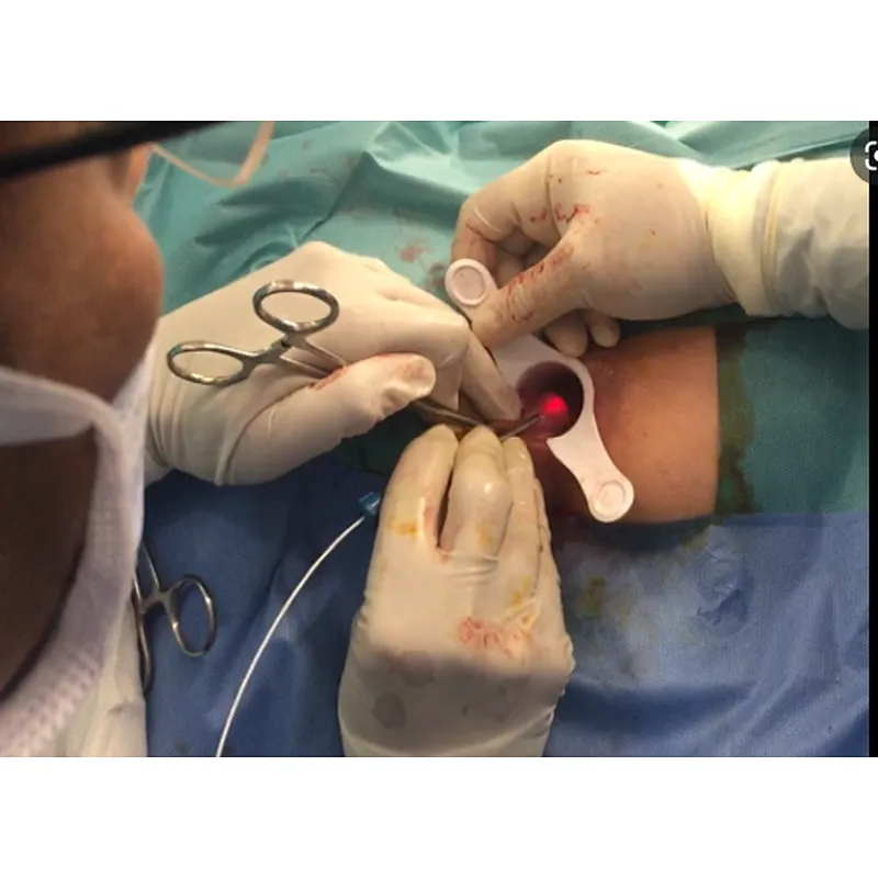 Hemorrhoids Diode Laser Instrument Treatment Device 1470nm Removal Anal Fistula Hemorrhoids 980nm Diode Laser