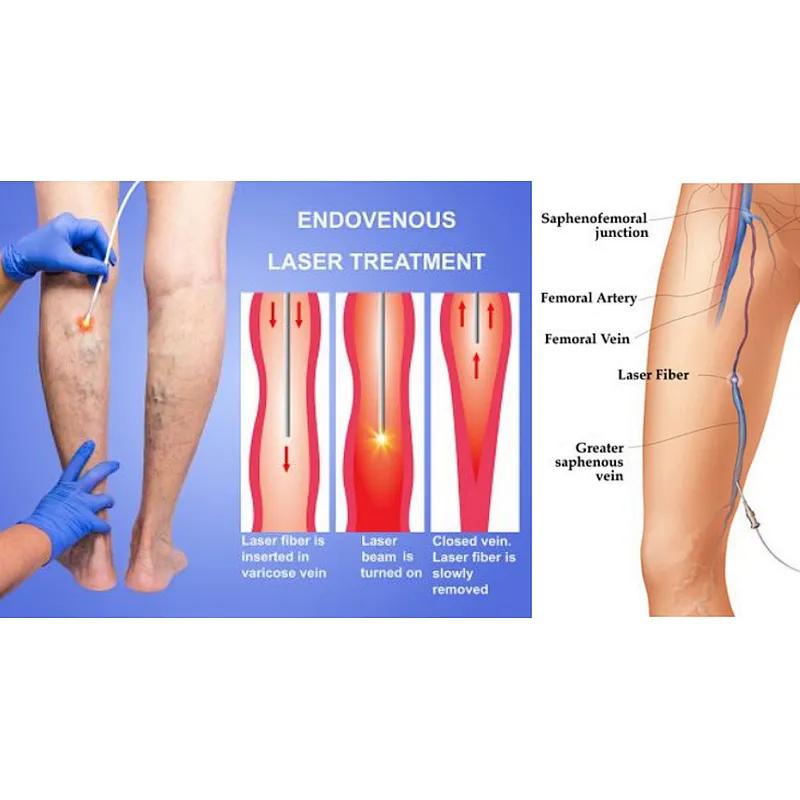 The Newest 980nm Laser  Varicose Veins EVLT EVLA Machine