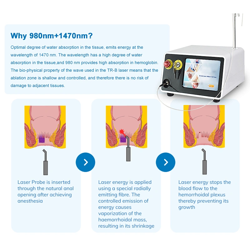 Medical Class IV Dual Wavelength 980nm 1470nm Diode Laser Hemorrhoid Treatment Surgical Device
