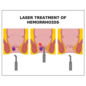 Hot Sale 980nm1470nm Proctology Diode Laser Hemorrhoids(HeLP Procedure) Surgery Machine Treatment Anal Fistula