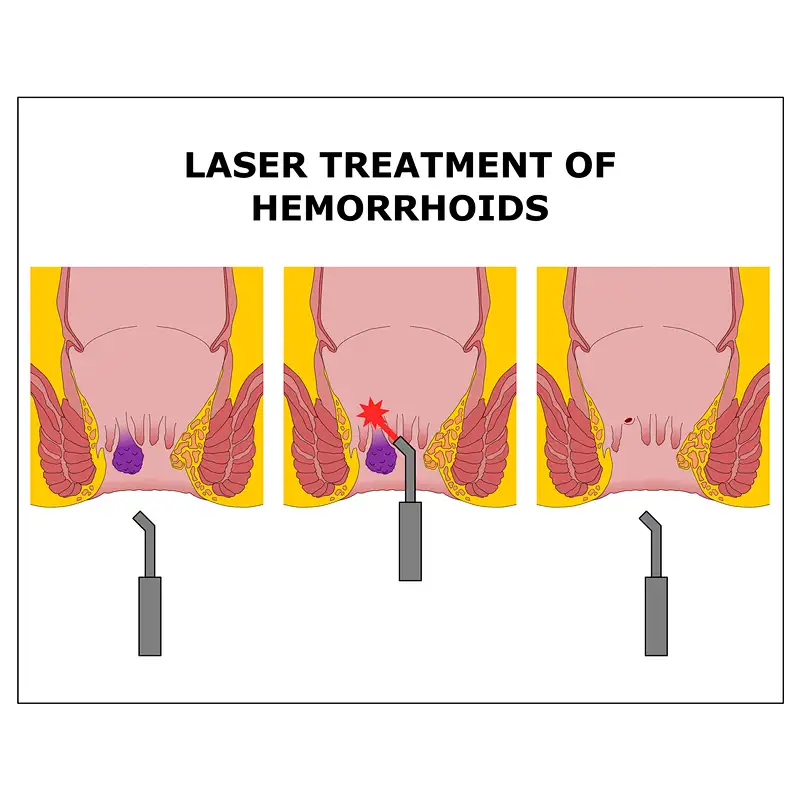 Hot Sale 980nm1470nm Proctology Diode Laser Hemorrhoids(HeLP Procedure) Surgery Machine Treatment Anal Fistula