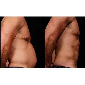 Laser  Lipolysis 980nm 1470nm Double Chin Removal Laser Machine