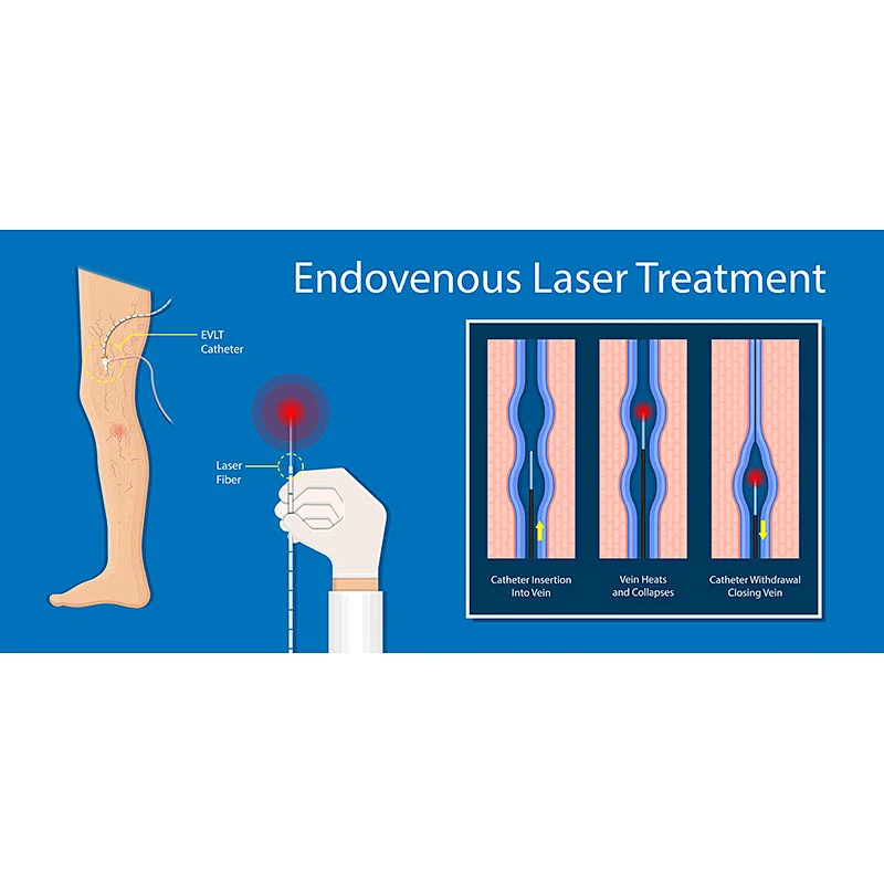 980nm EVLT Varicose Vein Laser Treatment 1470nm Diode Fiber Laser Mini-invasive EVLT Surgery