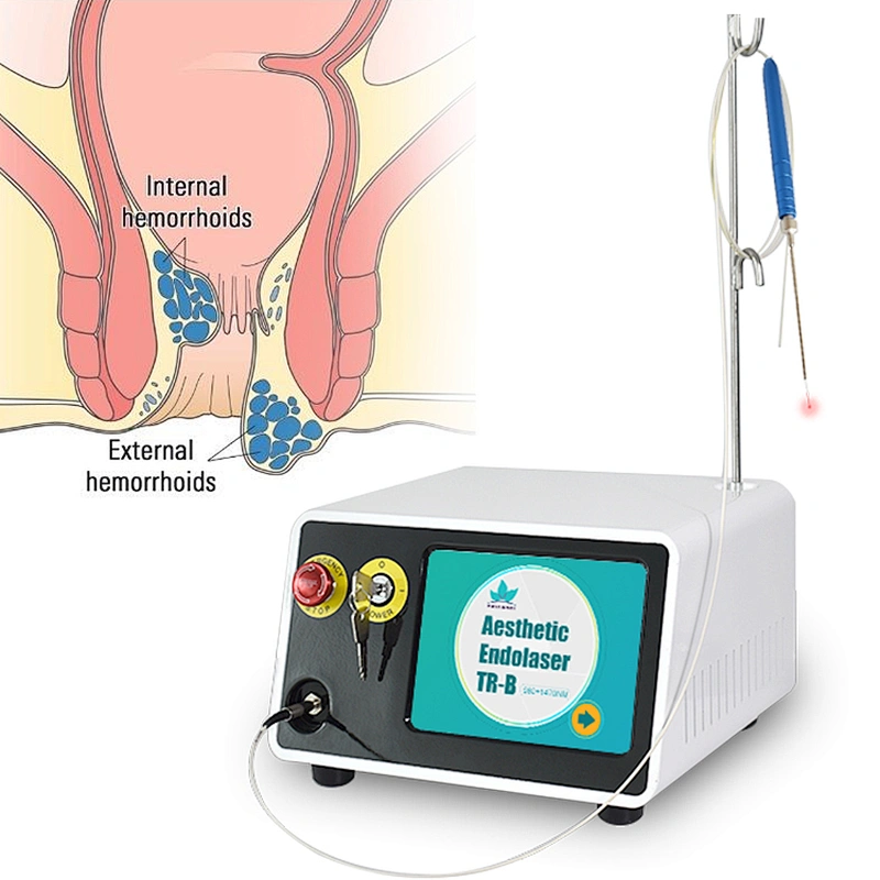 Hot Sale Portable 980nm 1470nm Hemorrhoid Diode Laser Excision Device for Proctology Hemorrhoid Piles Treatment