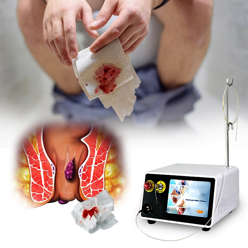 980 1470nm Surgery Proctology Laser Anal Fistula Hemorrhoids Surgery Proctology Laser Equipment