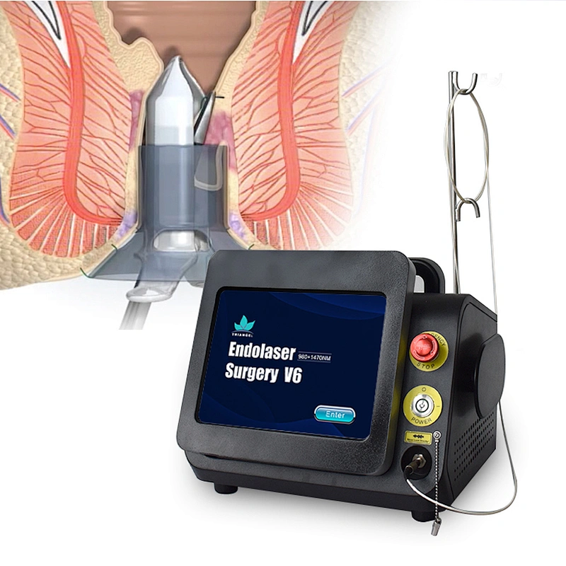 2024 Best Sell Proctology Laser Surgery Diode Laser Proctology Haemorrhoids 980nm 1470nm