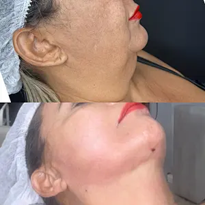 Triangel 980nm Laser Skin Tightening Eyebags  Lipolysis  Machine