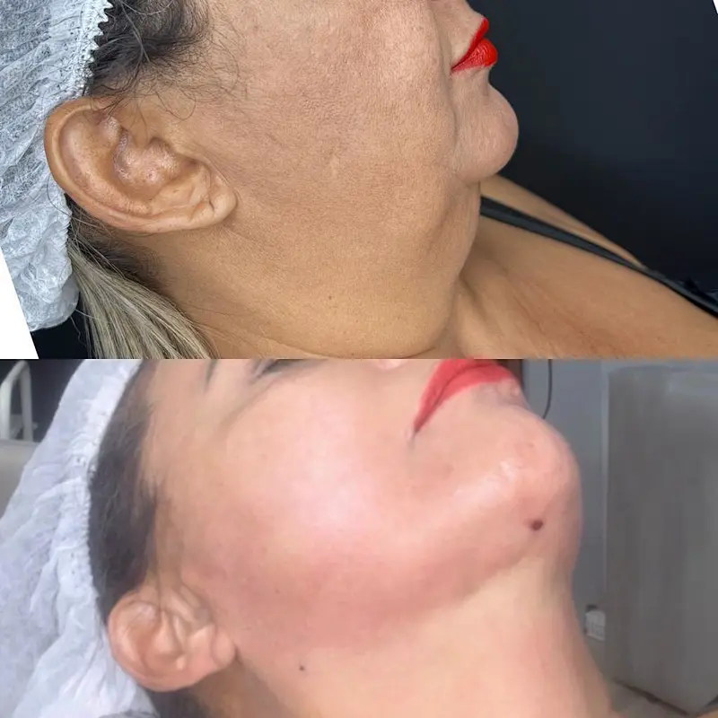 Triangel 980nm Laser Skin Tightening Eyebags  Lipolysis  Machine