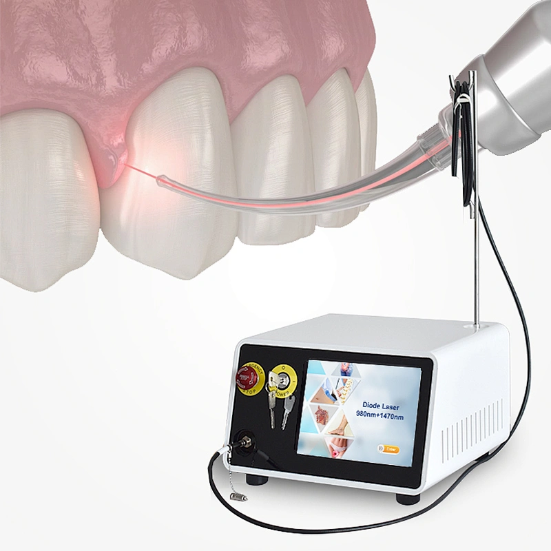 Dual Wave 810nm 980nm 1470nm Diode Laser Therapy Dental Soft Tissue Laser Machine