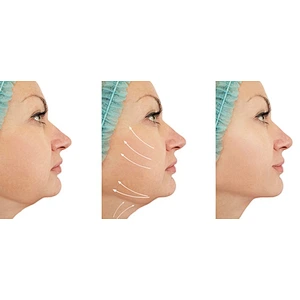 Powerful 980nm Diode Laser Fiber Machine for Liposuction & Fat Burning 1470nm Laser for Body & Face Lifting CN Plug