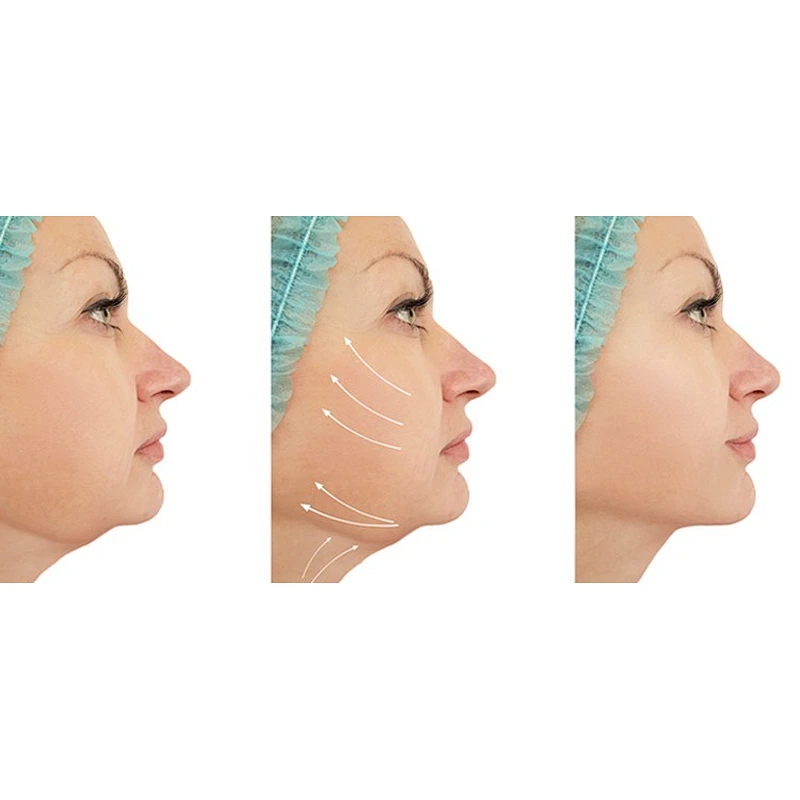 Powerful 980nm Diode Laser Fiber Machine for Liposuction & Fat Burning 1470nm Laser for Body & Face Lifting CN Plug