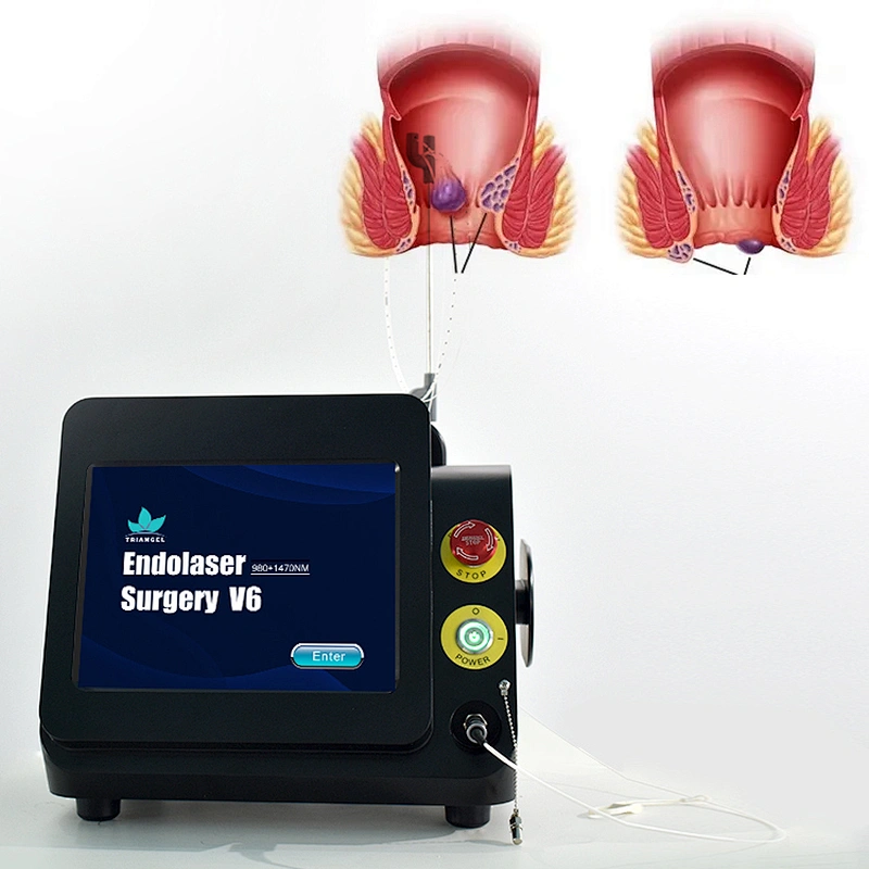 980nm1470nm Minimally Invasive Treatment Device Diode Hemorrhoidectomy Laser