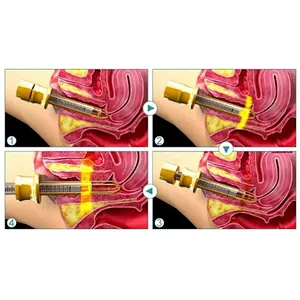 Laser Vaginal Rejuvenation Laser Therapy Wand Vaginal Tightening Rejuvenation Diode Laser 980nm 1470nm