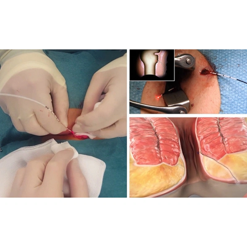 980 1470nm Surgery Proctology Laser Anal Fistula Hemorrhoids Surgery Proctology Laser Equipment