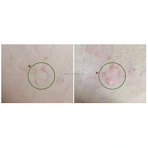 Newest 980nm Diode Laser Vascular Remove 980nm 30w Laser Machine for Spider Treatment Beauty Treatment