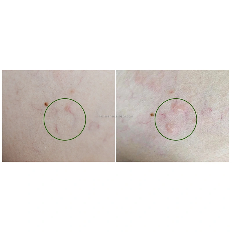 Newest 980nm Diode Laser Vascular Remove 980nm 30w Laser Machine for Spider Treatment Beauty Treatment