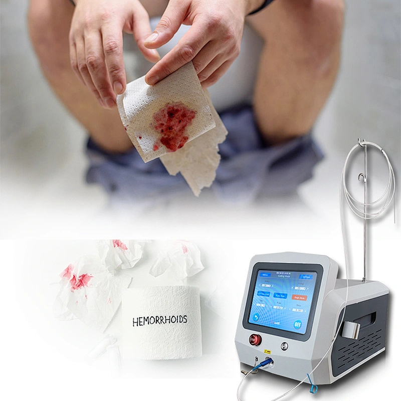 Hemorrhoids Diode Laser Treatment Proctology Surgery Machine 980nm1470nm Hemorrhoids Laser Removal Anal Fistula Hemorrhoids
