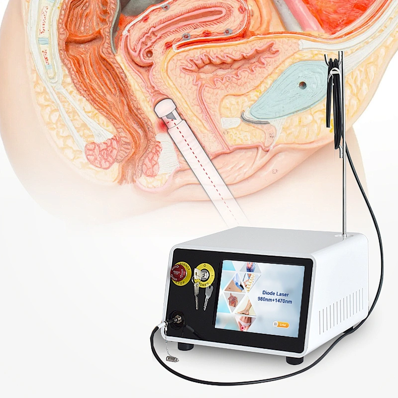 1470nm Laser Gynecology Laser Vaginal Atrophy Uterine Fibroids  Ovarian Fibroids Treatment Laser Machine