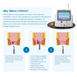 Anal Fistula Internal External Hemorrhoids Remover Piles Laser Radial Fiber 980nm 1470nm Piles Surgical Laser Instrument