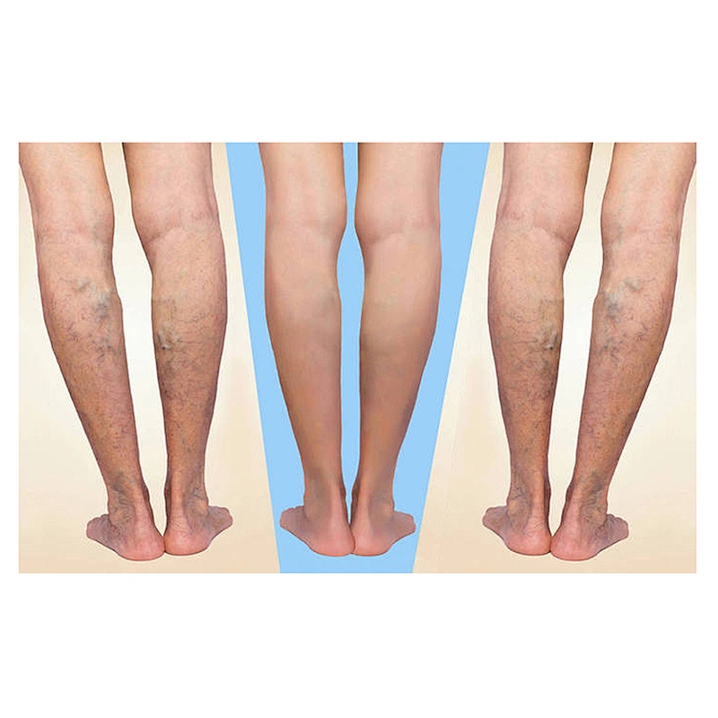 2025 Leg Vein Varicose Removal Machine Treatment EVLT 980nm1470nm Spider Veins Vascular Removal Device