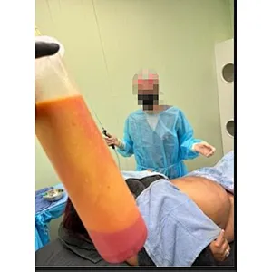 2025 Newest Vaser Liposuction Diode Laser 980nm1470nm Lipolysis Skin Tightening Machine Endolaser Facial Lifting