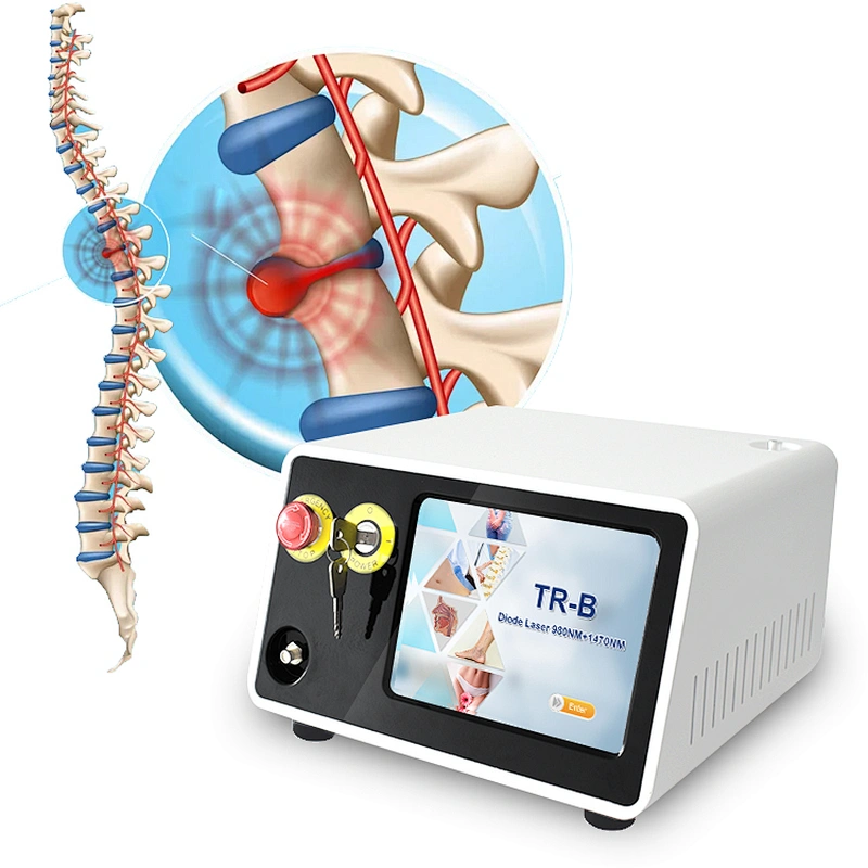 980nm 1470nm Herniated Disc Laser Therapy PLDD Laser