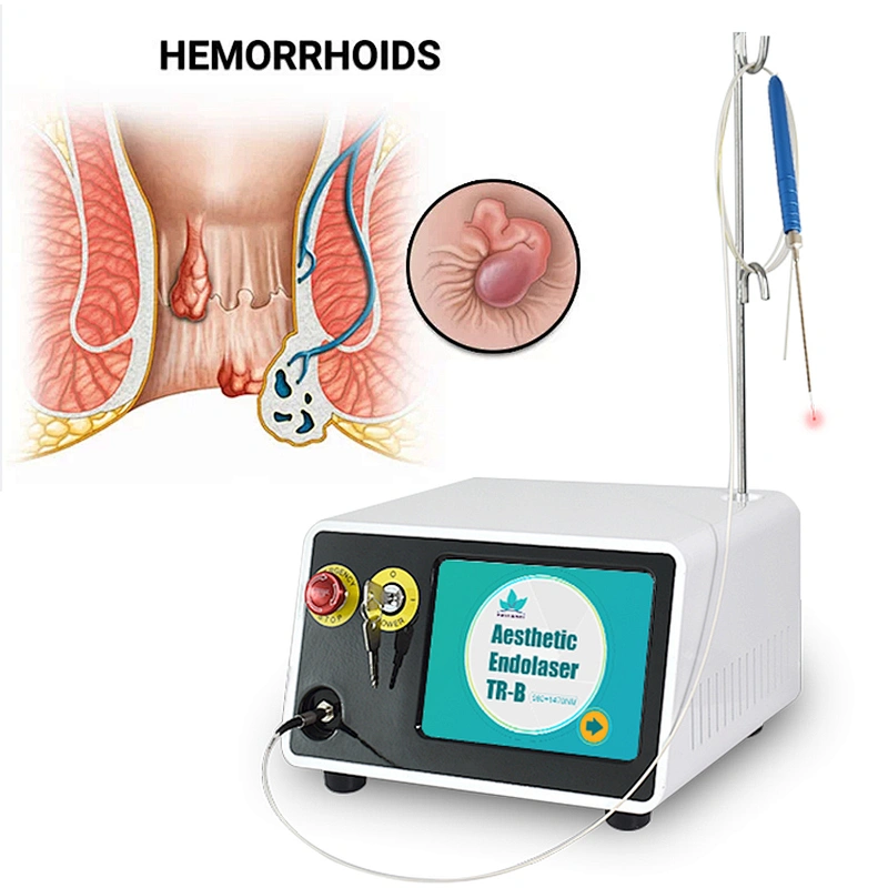 Hot Sale Portable 980nm 1470nm Hemorrhoid Diode Laser Excision Device for Proctology Hemorrhoid Piles Treatment