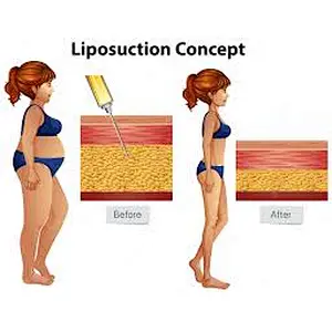 Best Minimally Invasive Facial Sculpting Neck Lifting Treatment Diode Laser 980nm 1470nm Laser