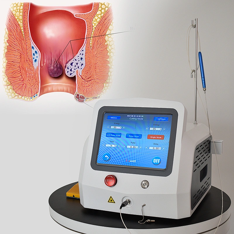 2024 Newest 980nm 1470nm Diode Laser 47w Hemorrhoids Fistula Laser Treatment Bloodless