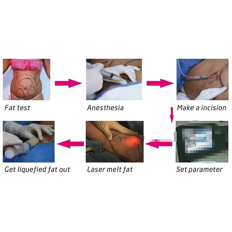 2024 Hot Sale Laser Lipolysis 980nm 1470nm Diode Laser Slimming Machine Fat Reduction Facelift Machine
