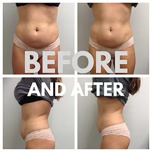 Lipo Vaser Diode Laser Slimming Fat Burning Lipolysis Injection Laser Lipolysis Device Endolaser Lifting Machine