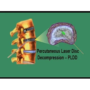 High Powerful Disc Decompression 980nm 1470nm 1470nm Laser PLDD Spinal Method Treatment Machine