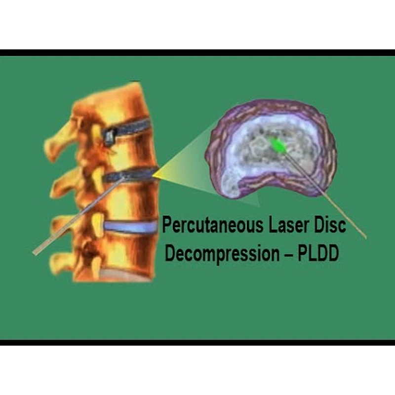 High Powerful Disc Decompression 980nm 1470nm 1470nm Laser PLDD Spinal Method Treatment Machine
