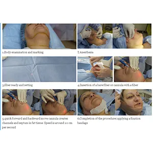 Fibra Optica Cirurgica Para Lipolise Wholesales Custom Liposucton 980+1470nm Laser Machine for Beauty Salon Equipment
