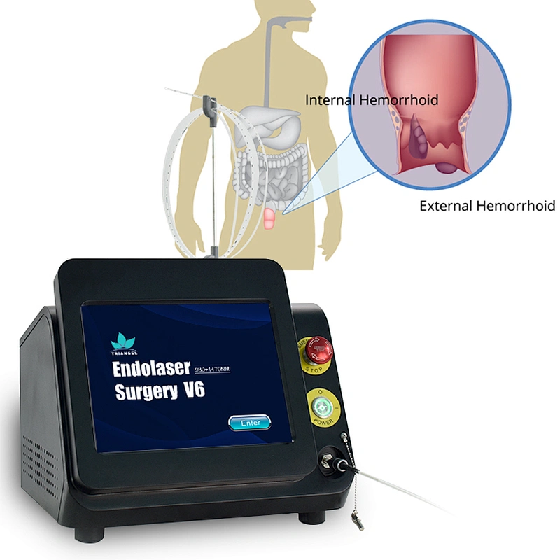 980nm 1470nm Diode Laser for Hemorrhoids Anal Fistula Surgery Effectively Painless Doctor Use Advanced Tech