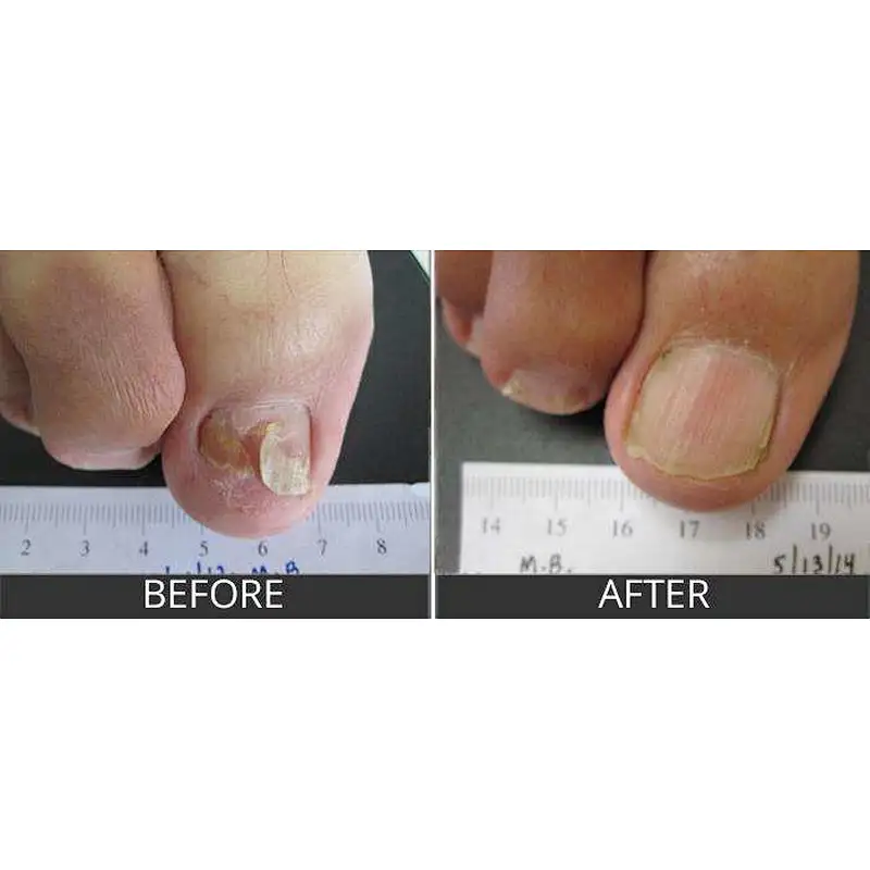 Hot Sale Nail Fungus Treatment Laser 1064nm Onicomicosis Fungus Nail Toenail Fungus Onicomicose Laser 980 nm 1210nm Machine
