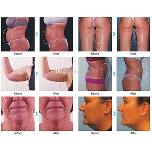 Best Sale 980nm 1470nm  Laser Lipolysis Laser Device  Liposuction Machine